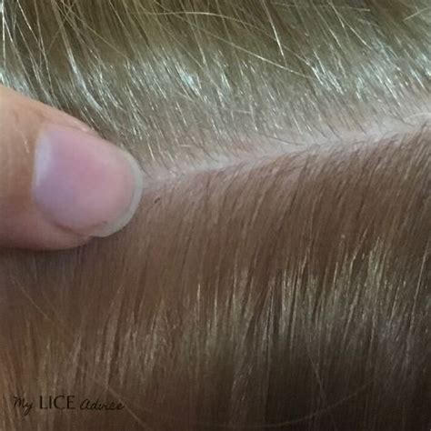 What Do Lice Eggs Look Like In Blonde Hair Infoupdate Org