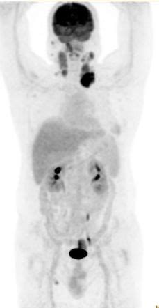 Elastofibroma Dorsi Pet Ct Image Radiopaedia Org