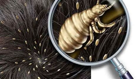 How To Check Yourself For Lice How To Tell If You Have Lice By Yourself