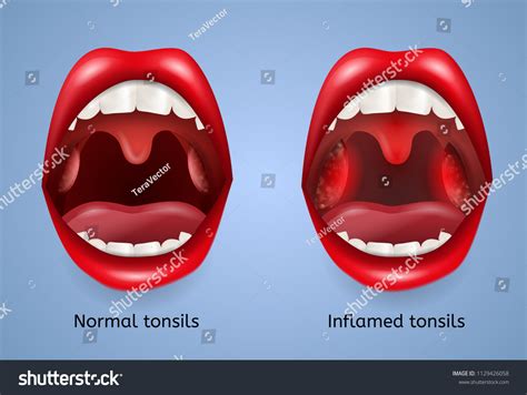 93 Normal tonsil Images, Stock Photos & Vectors | Shutterstock