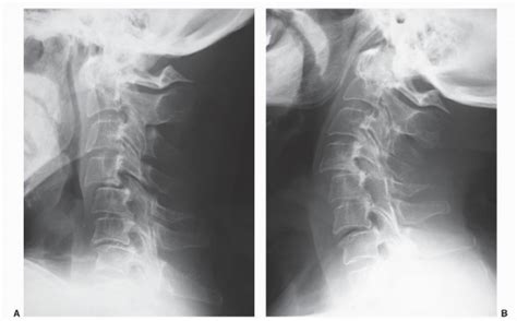 Subaxial Cervical Involvement In Rheumatoid Arthritis Neupsy Key