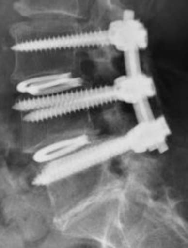 Posterior Lumbar Interbody Fusion Plif Private Neurosurgeon Hull