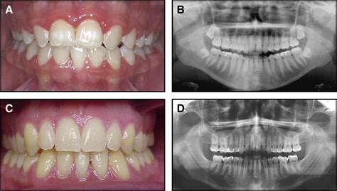 Incidence Of Open Gingival Embrasures After Mandibular Incisor