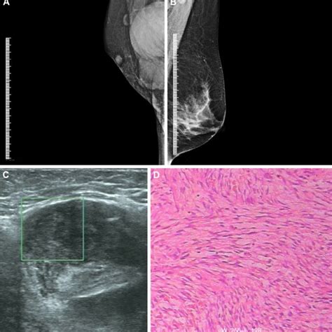 Phyllodes Tumor Of The Breast With Hypoglycemia Characteristics Of