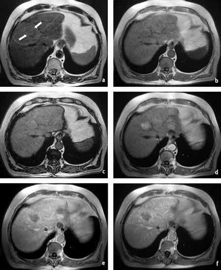 Contrast Agents for Liver MR Imaging - MRI of the Liver