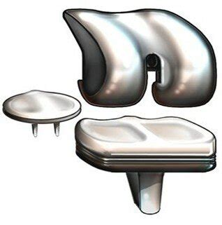 Components of knee arthroplasty | Download Scientific Diagram