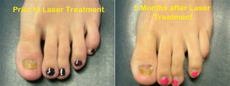 Laser Treatment for toenail fungus | more effective than Loceryl