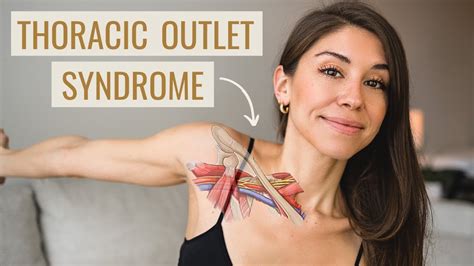 Thoracic Outlet Syndrome Exercises (HOW TO FIX IT!) - Causes, Symptoms ...