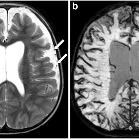 Loss Of Graywhite Matter Differentiation In A 9 Year Old Boy With