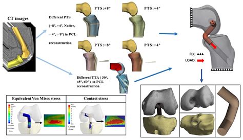 JCM Free Full Text Influence Of The Tibial Tunnel Angle And