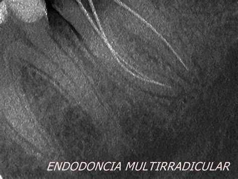 Endodoncia Multirradicular Casos Cl Nicos De Xito I Cl Nica Los Valles