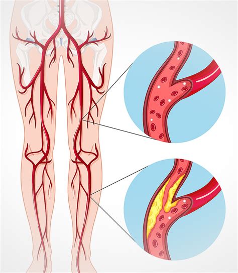 Autocuidados Para Doença Arterial Periférica BRAINCP