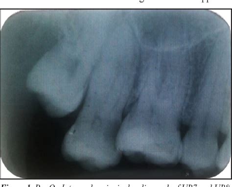 Figure 1 From Hypercementosis And Concrescence Of Maxillary Second