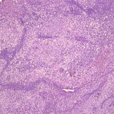 Histopathology Showing Renal Cell Carcinoma Download Scientific Diagram