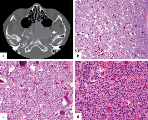 A Axial Ct Image Of Juvenile Psammomatoid Ossifying Fibroma