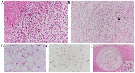 Histopathology Diaphragmmetastatic Liposarcoma Video