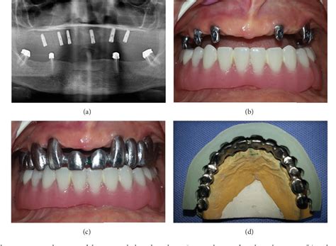 a suge Excelent Costume telescopic implant overdenture întreprinde