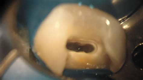 Endodontia Microscópica dente 25 YouTube