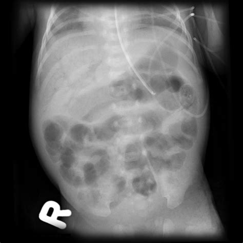 Portal Venous Gas Neonate Image Radiopaedia Org