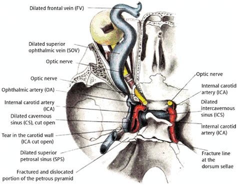 Cavernous Sinus Internal Carotid Artery