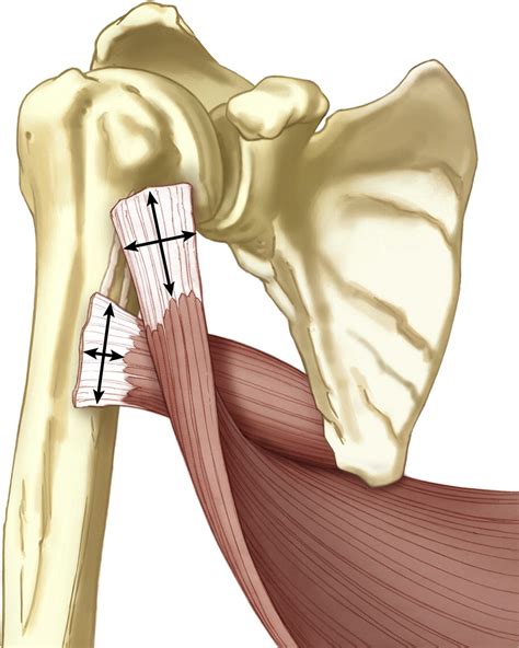 A To C Schematic Drawing Of The Latissimus Dorsi Ld Teres Major Tm