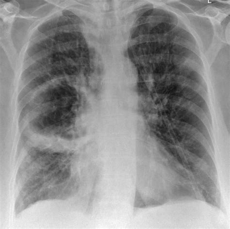 Lung abscess | Radiology Reference Article | Radiopaedia.org ...