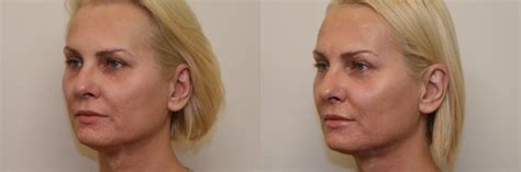 Laser Treatments Before And After Photo Gallery Atlanta Georgia