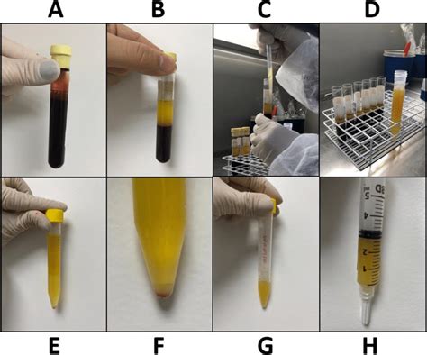 Preparation Of Platelet Rich Plasma Prp And Plasma A Blood