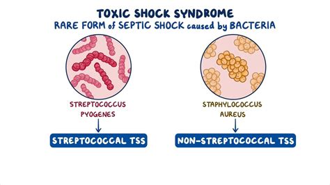 Toxic Shock Syndrome Video And Meaning Osmosis