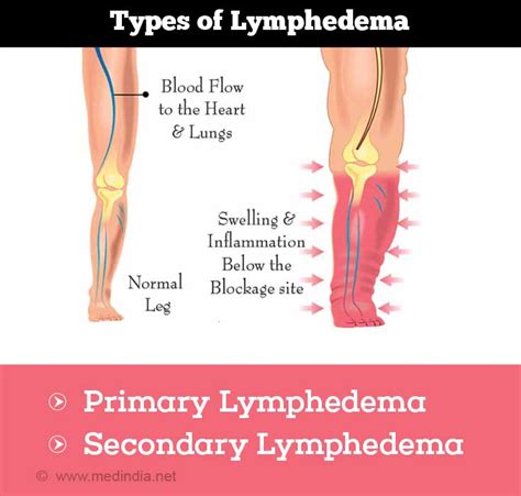 Lymphedema Types Causes Symptoms Diagnosis Treatment