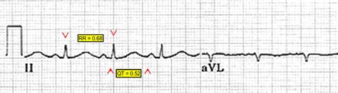 Qtqtc Interval Monitoring In The Emergency Department Journal Of