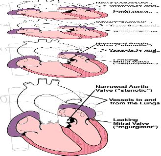 Mitral Valve Regurgitation