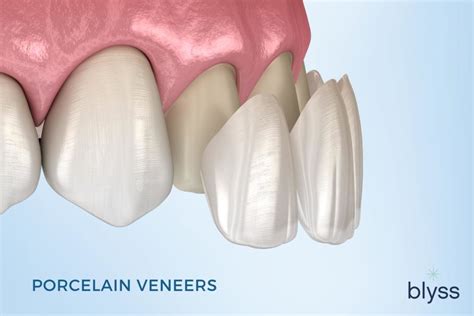 Veneers Cost Top 8 Factors That Affect Cost And How To Save