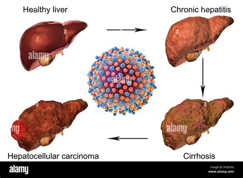 Stages Of Liver Disease In Hepatitis C Fotos E Im Genes De Stock Alamy