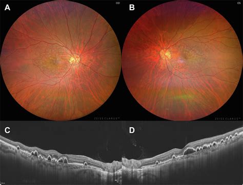 Bilateral Idiopathic Multifocal Retinal Pigment Epithelial Detachments