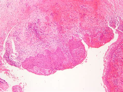 Infected Cyst