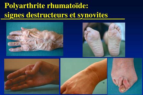 PPT Polyarthrite rhumatoïde PowerPoint Presentation free download