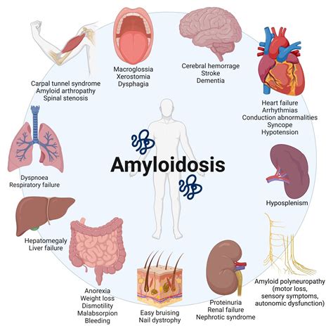 Multidisciplinary Care For Patients With Cardiac Amyloidosis A Lesson