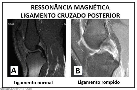 Les O Do Ligamento Cruzado Posterior Dr M Rcio Silveira