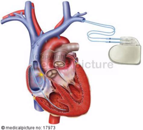 Herz Mit Schrittmacher DocCheck