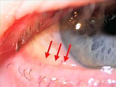 Conjunctival Chalasis Conjunctivochalasis Eye Pain That Mimicks Dry