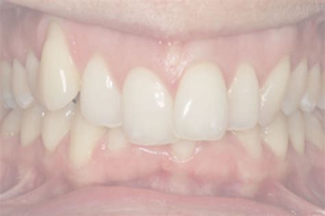 Invisalign Case Study Part One The Deep Bite Dentistry Online