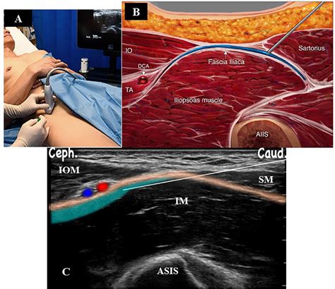 Supra Inguinal Fascia Iliaca Compartment Block For Postoperative