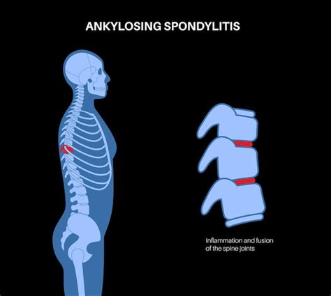 Premium Vector Ankylosing Spondylitis Arthritis That Causes