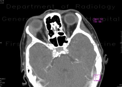 Radiology Case Pseudotumour Of Lacrimal Gland