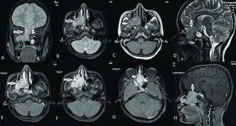 Proton Density With Fat Saturation PD FS Coronal A And Axial B