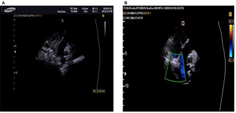 Transthoracic Echocardiogram Parasternal Short Axis View Notes A And