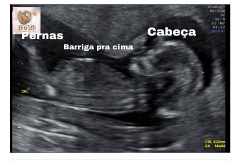 Quando Fazer A Primeira Morfológica - 1 Morfológica | BabyCenter