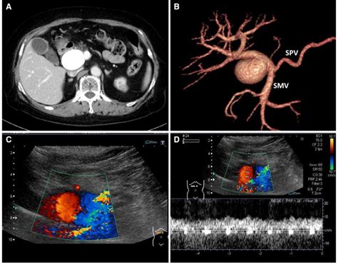 Contrast Enhanced Computed Tomography Ce Ct And Doppler Download