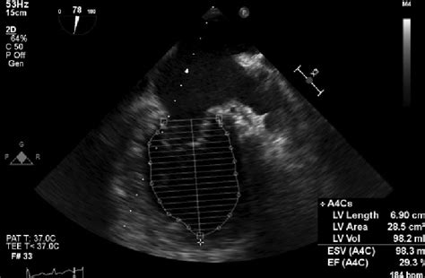 Transesophageal Image Showing Dilated Left Ventricle With Severely